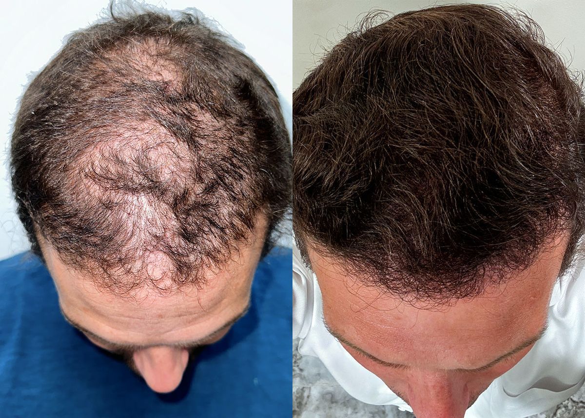 Hair transplant